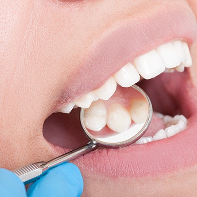 Closeup of patient receiving dental exam