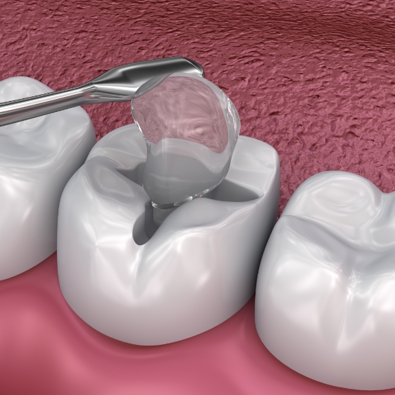 Illustration of a white filling being placed inside of a tooth