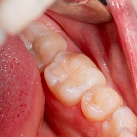 Close up of a row of teeth with tooth colored fillings