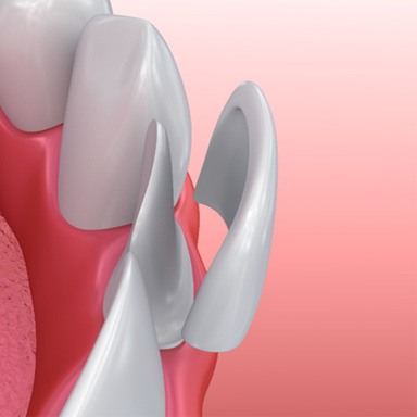 close-up illustration of a dental veneer