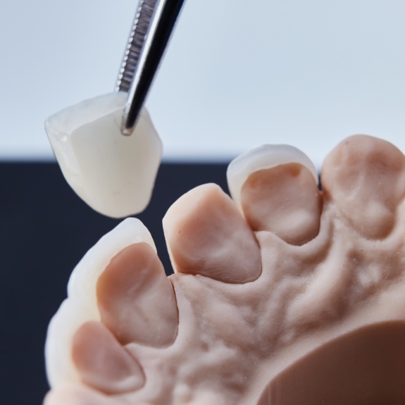 Tweezers placing a veneer over the front surface of a model of a tooth
