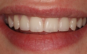 veneers patient after treatment