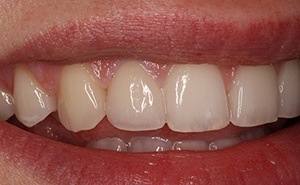 veneers patient after treatment