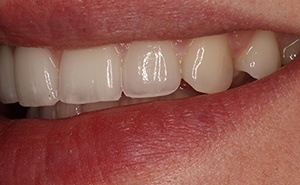 veneers patient after treatment