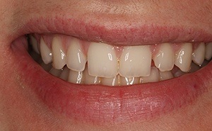 veneers patient before treatment