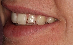 veneers patient before treatment