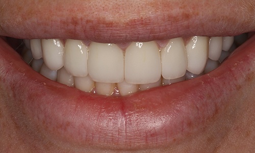 Head-on shot of smile after treatment