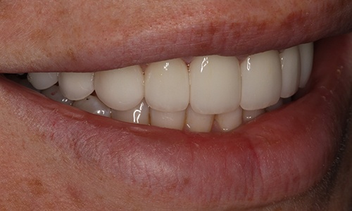 Close-up of smile after treatment viewed from patient's right