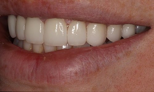 Close-up of smile after treatment viewed from patient's right