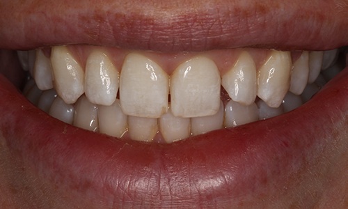 Head-on shot of smile before treatment