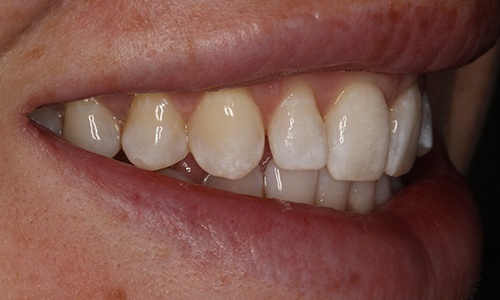 Close-up of smile before treatment viewed from patient's right
