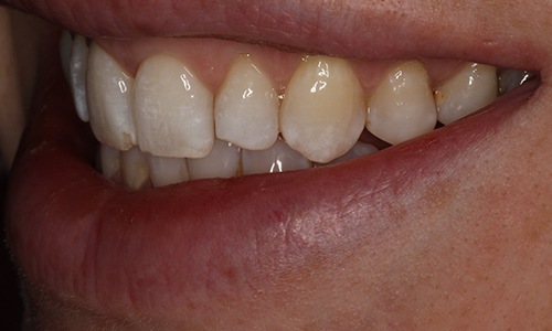Close-up of smile before treatment viewed from patient's left