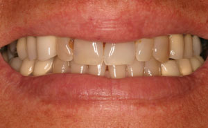 Discolored teeth closeup