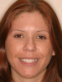 Headshot young woman before treatment