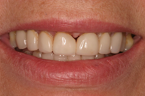 Closeup damaged decayed top teeth