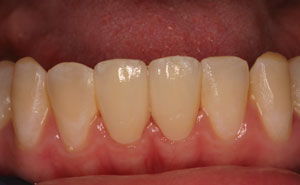 Closeup repaired bottom teeth