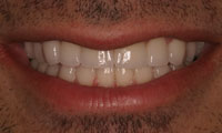 Man in 30s after treatment closeup