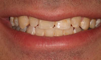 Man in 30s before treatment closeup
