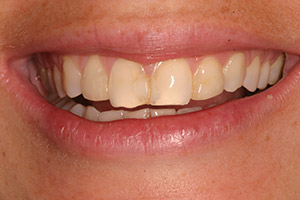 Closeup of damaged smile