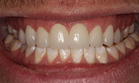 Young man after porcelain veneers closeup