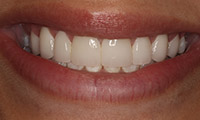 Young woman after porcelain veneers closeup