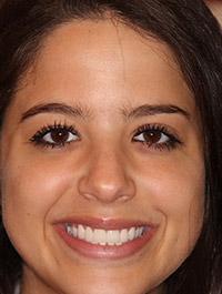 Young woman after porcelain veneers