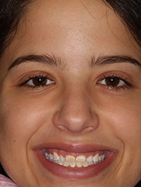 Woman with gummy smile before treatment