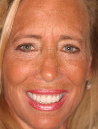 Older blonde woman after treatment