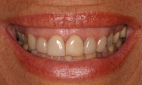 Older blonde woman before treatment closeup