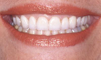 Closeup senior woman after treatment