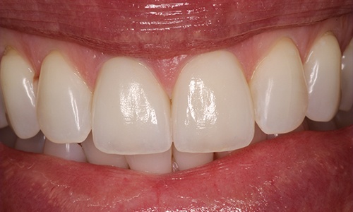 Smile with chipped tooth covered by veneer