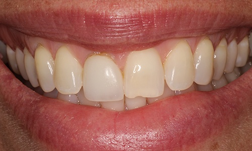 Close-up of smile with slightly chipped front tooth