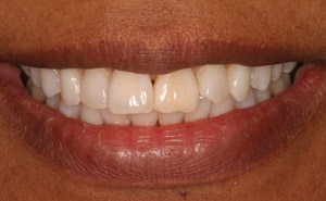 White teeth after whitening