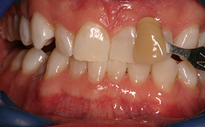 White teeth after whitening