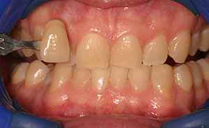 Yellow smile before whitening