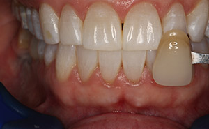 Brilliant white smile after teeth whitening