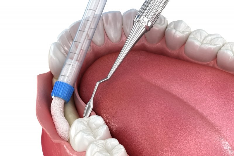 digital rendering of a bone graft