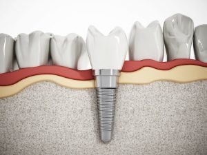 dental implant detail