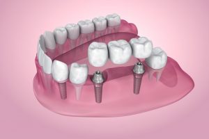 dental implant bridge 