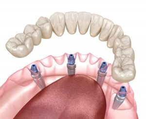 Illustration of All-on-4 dental implants for lower arch