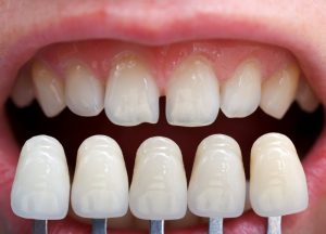 Porcelain veneers next to imperfect teeth.