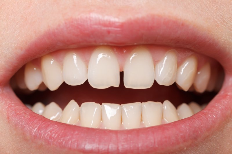 Porcelain Veneers Can Finally Close That Front Teeth Gap