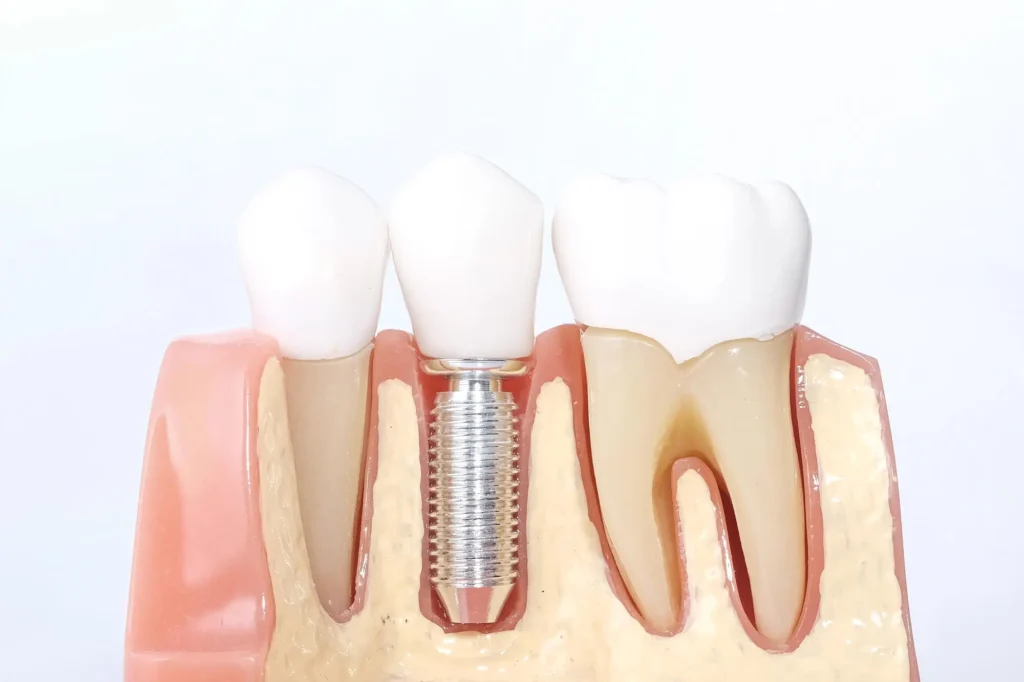 Dental Implants Massapequa Model Demonstrating Tooth Replacement
