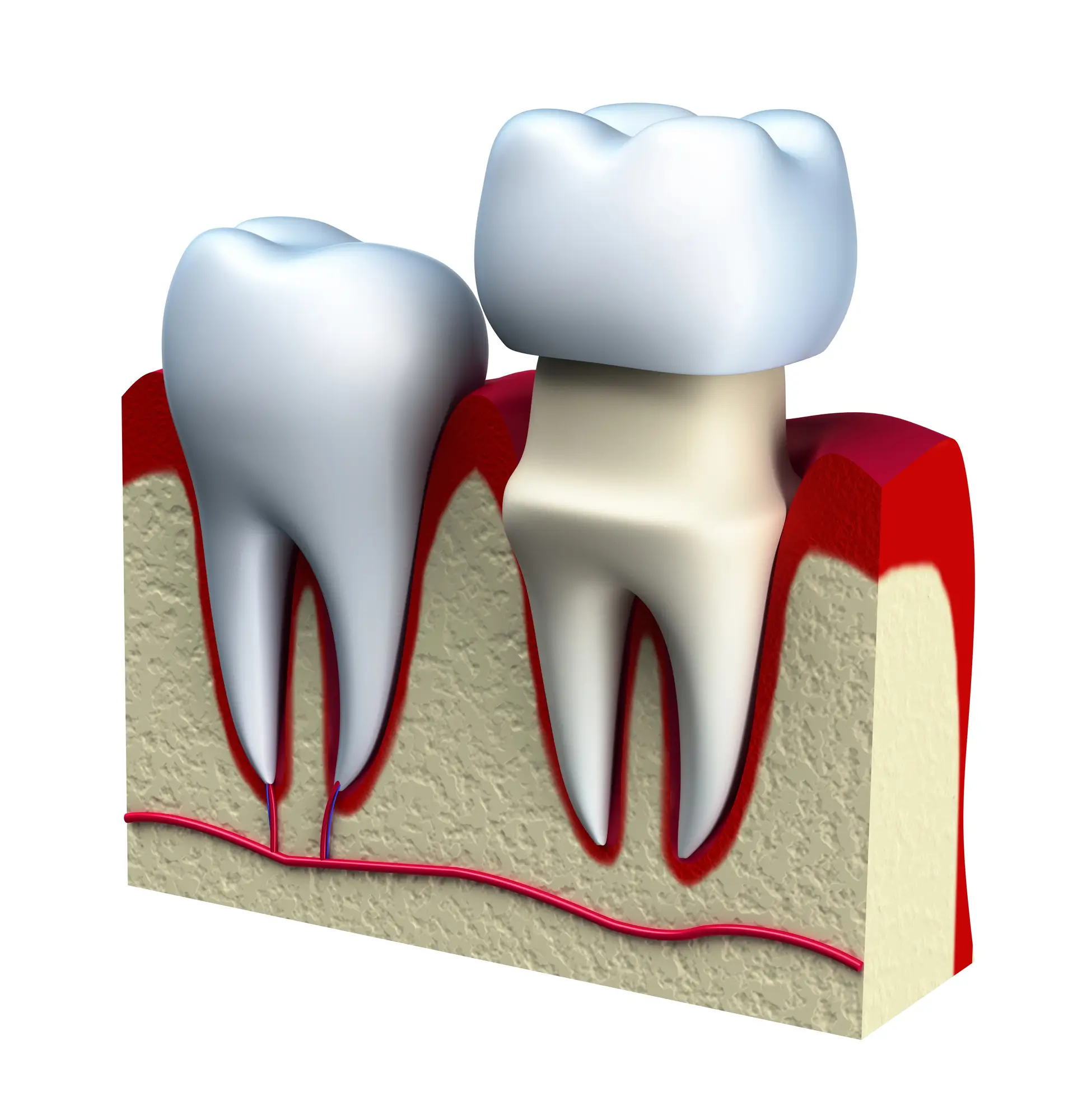 Dental crown installation by a dentist in Massapequa