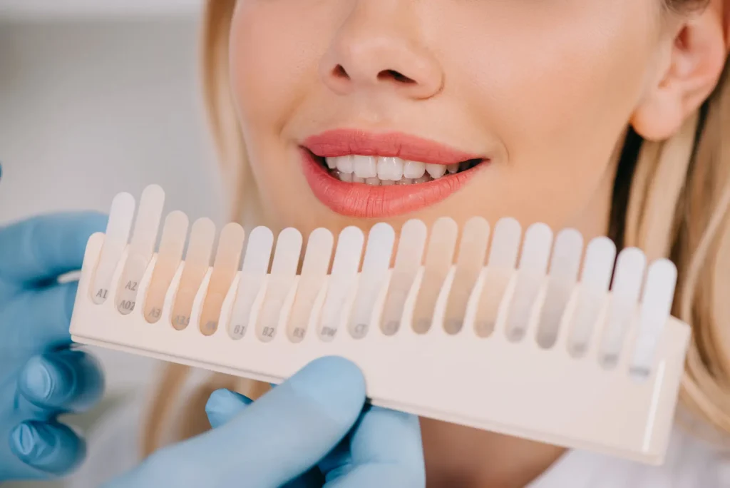 Shade Matching for Teeth Whitening in Massapequa