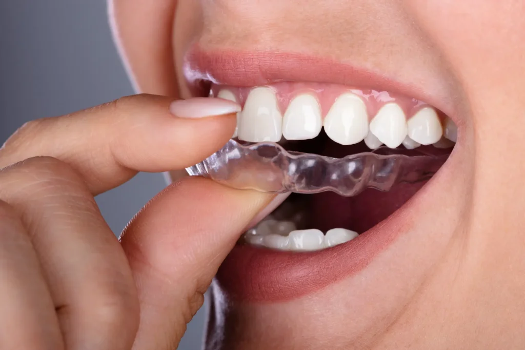 Woman placing Invisalign Massapequa transparent aligner on teeth