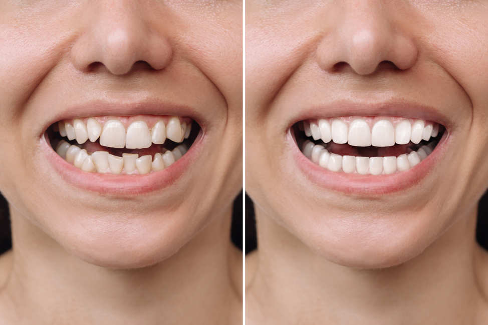 woman’s teeth before and after veneers